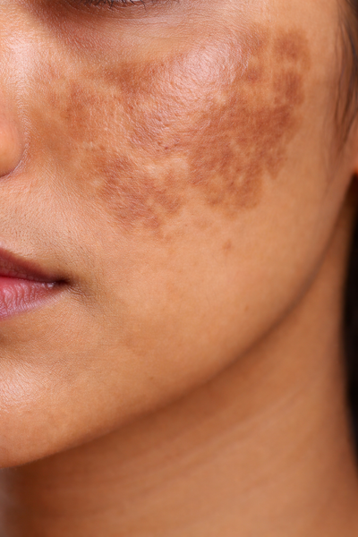 Close-up of a person's face with visible brown patches on the skin.